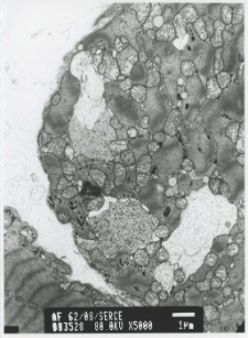 Studies of heart ultrastructure in various diseases by prof A. Fidziańska-Dolot: heart failure - 62/08