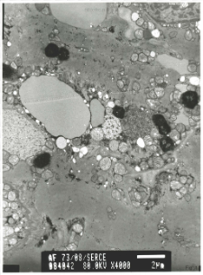 Studies of heart ultrastructure in various diseases by prof A. Fidziańska-Dolot: heart failure - 73/08