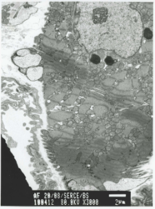 Studies of heart ultrastructure in various diseases by prof A. Fidziańska-Dolot: myocarditis - 20/08