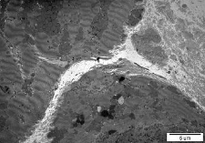 Studies of heart ultrastructure in various diseass by dr Michal Walski: dilated cardiomyopathy - 31/2000