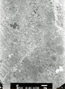 Studies of heart ultrastructure in various diseases by prof A. Fidziańska-Dolot: dilated cardiomyopathy - 2003