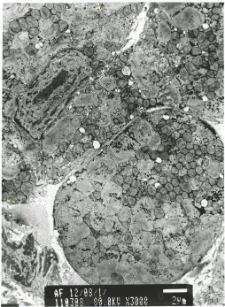 Studies of heart ultrastructure in various diseases by prof A. Fidziańska-Dolot: myocarditis - 12/08