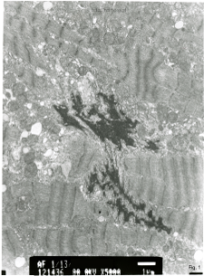 Studies of heart ultrastructure in various diseases by prof A. Fidziańska-Dolot: heart failure - 1/13