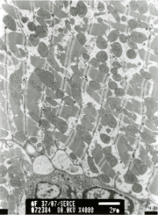 Studies of heart ultrastructure in various diseass by prof A. Fidziańska-Dolot: arrhythmogenic cardiomyopathy - 37/07