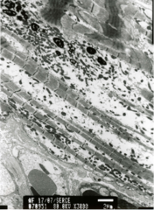 Studies of heart ultrastructure in various diseases by prof A. Fidziańska-Dolot: dilated cardiomyopathy - 17/07