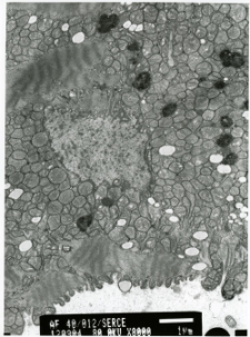 Studies of heart ultrastructure in various diseass by prof A. Fidziańska-Dolot: cardiomyopathy - 40/12