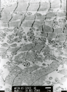 Studies of heart ultrastructure in various diseass by prof A. Fidziańska-Dolot: cardiomyopathy - 20/05