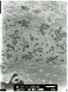 Studies of heart ultrastructure in various diseass by prof A. Fidziańska-Dolot: restrictive cardiomyopathy - 56/13