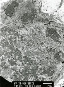 Studies of heart ultrastructure in various diseases by prof A. Fidziańska-Dolot: dilated cardiomyopathy - 39/10
