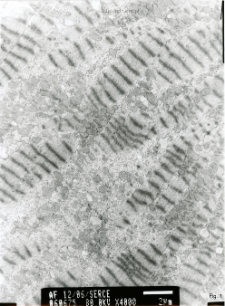 Studies of heart ultrastructure in various diseass by prof A. Fidziańska-Dolot: cardiomyopathy - 12/06